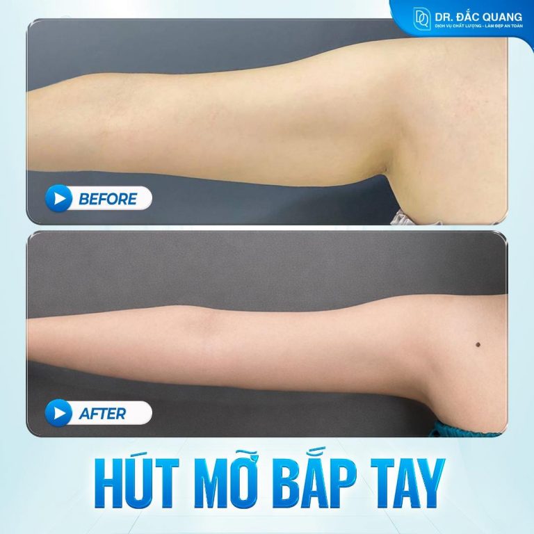Bắp tay Minh Châu 2