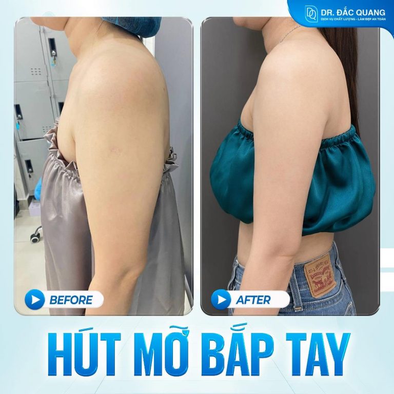 Bắp tay Minh Châu