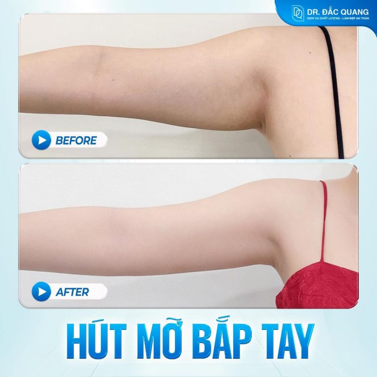 Bắp tay Mỹ Hằng