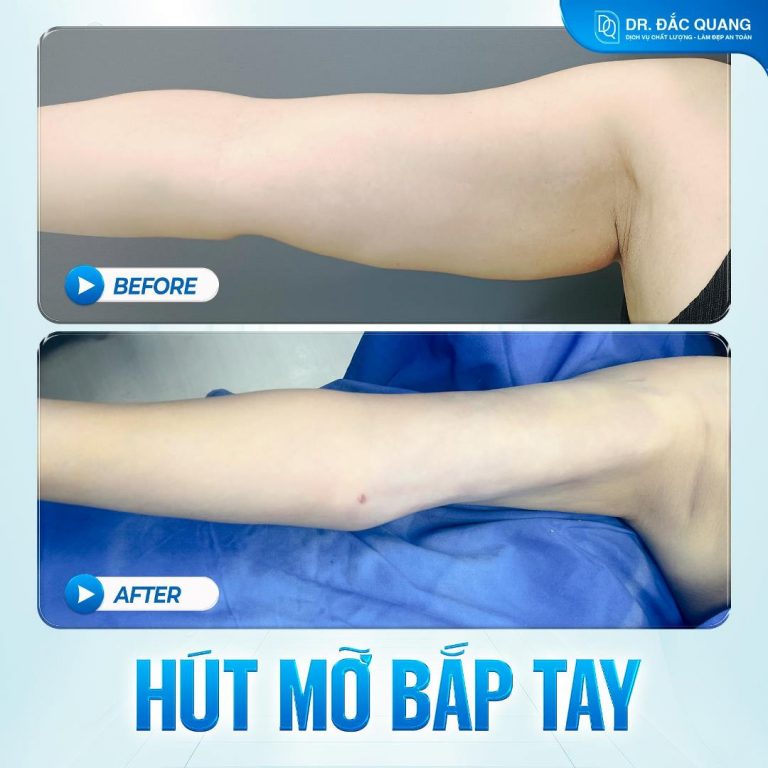 Bắp tay Trần thị ánh tuyết