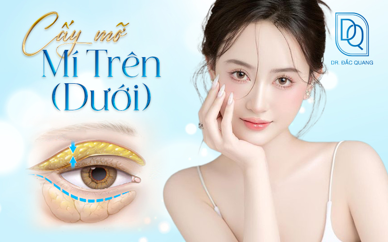 cấy mỡ mí trên dưới