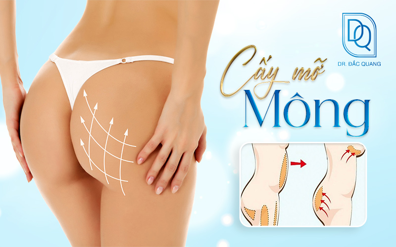 cấy mỡ mông