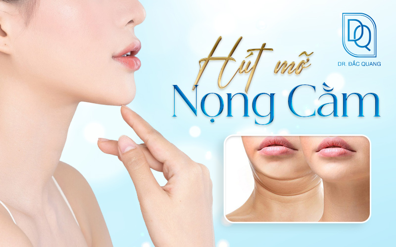 hút mỡ nọng cằm