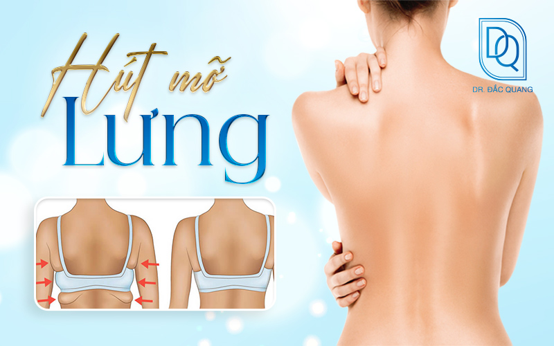 hút mỡ lưng