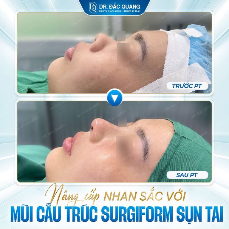 Kim Kiều (mũi ct)