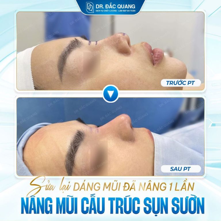 Lương Ngọc Tuyết Nhung (mũi ss sl)