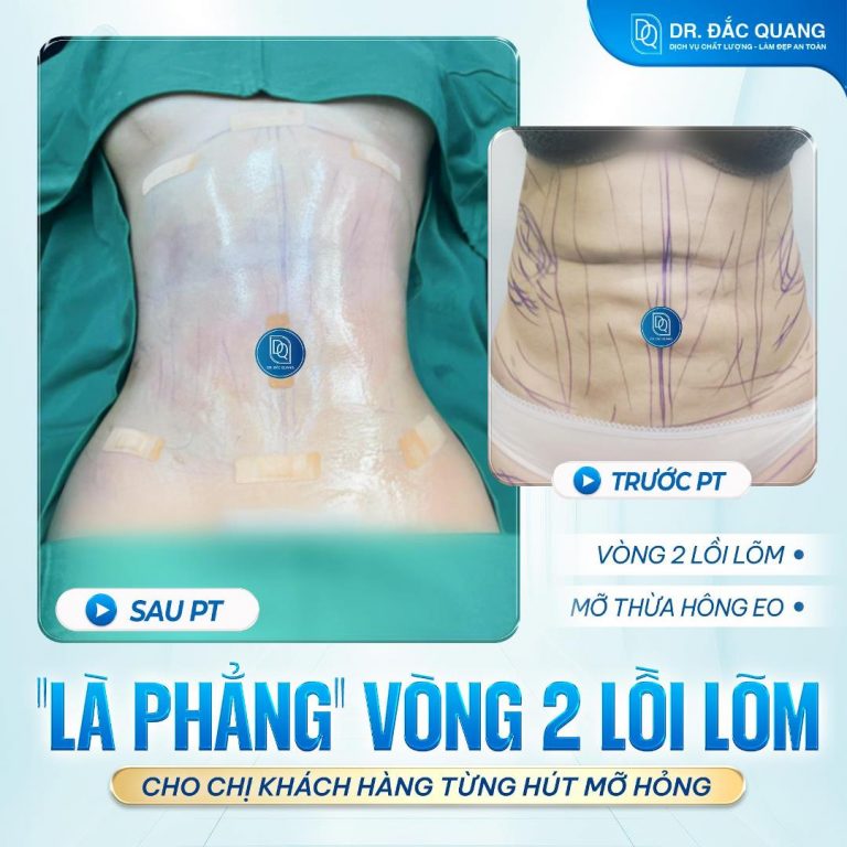 Ngọc Nữ (bụng) làm lại