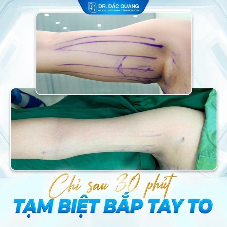 Nguyễn Ngọc Linh (HM bắp tay) làm lại