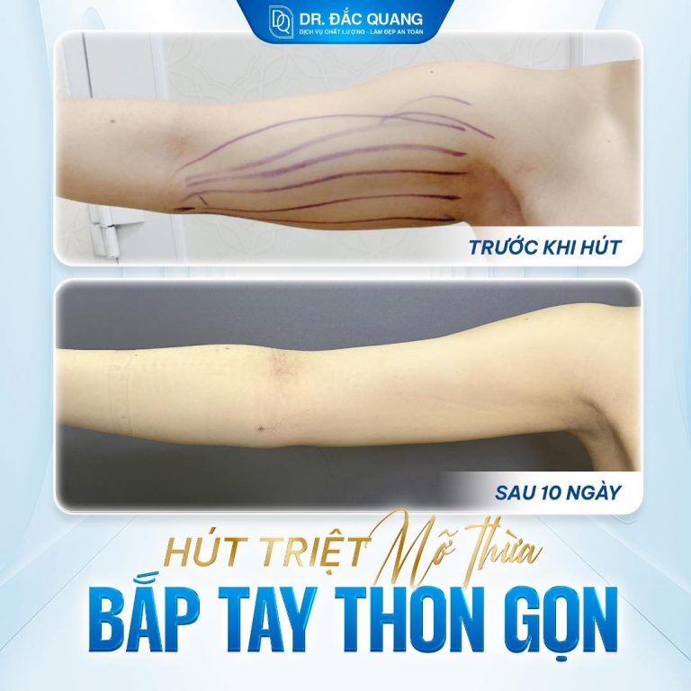 Nguyễn Thanh Hà hút mỡ tay làm lại