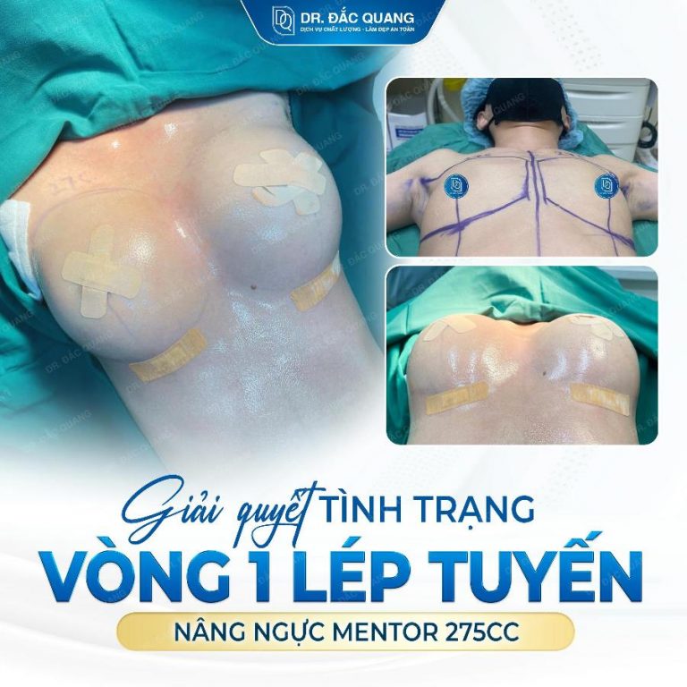 Nguyễn Thị Thanh Trâm (Ngực Mentor 275cc) PT