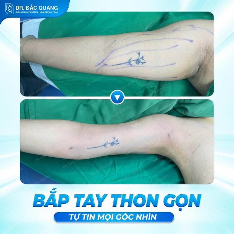 bắp tay Vũ Thị Châm Em