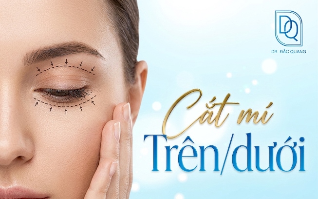 cắt mí trên dưới