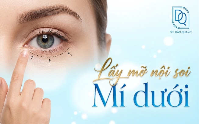 lấy mỡ nội soi mí dưới