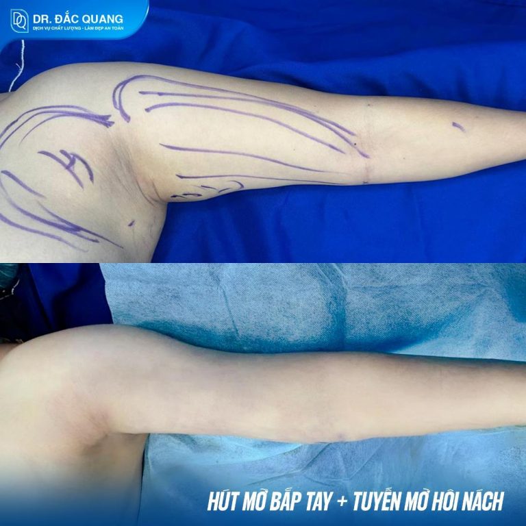 lê thị mỹ linh hút mỡ bắp tay