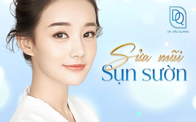 sửa mũi sụn sườn