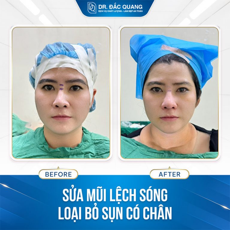 sửa mũi đặt sống